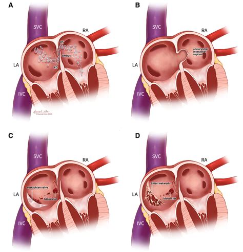 PFO Defect 的图像结果
