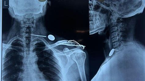 Indore News: Steel Nail Moves From Man’s Shoulder To Throat, Removed In ...