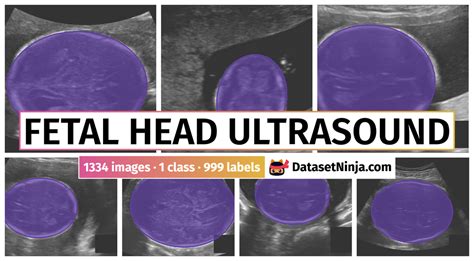 Fetal Head UltraSound - Dataset Ninja