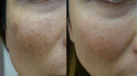 Laser Age Spot Removal | Laser Treatment for Age Spots | Cutis Clinic