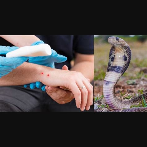 Snake Bite