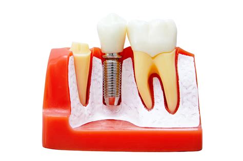 Dental Implant PNG Clipart - dental implant images