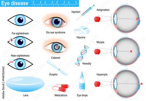 human eye diseases and disorders. Infographic Stock Vector | Adobe Stock