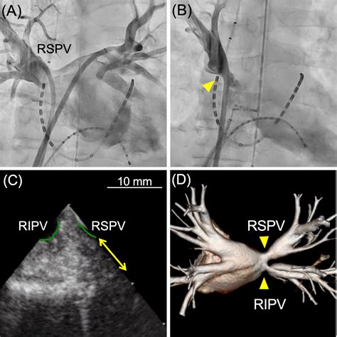 Acute pulmonary vein stenosis during radiofrequency catheter ablation ...