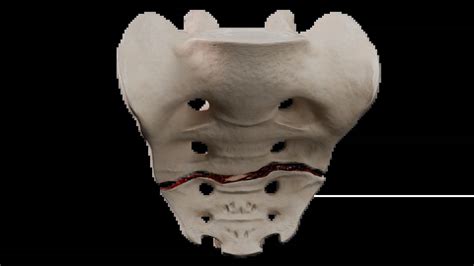 Sacral Fractures: Classification, Symptoms, Diagnosis, and Treatment