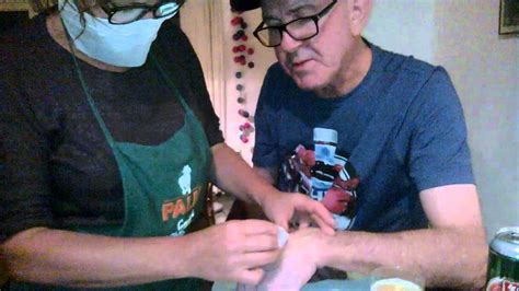 Image result for Carbuncle Extraction Doctor