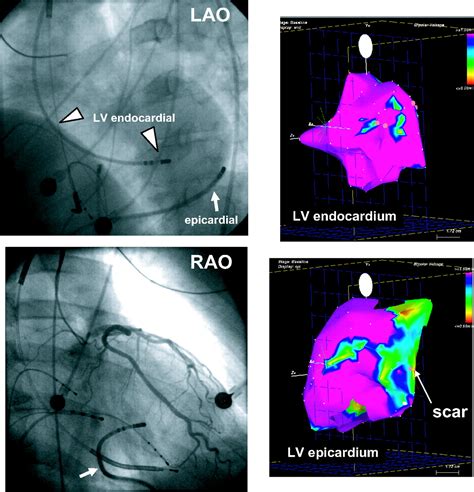 Heart Ablation Surgery Svt
