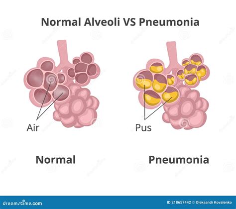 Normal Lung Alveoli Versus Pneumonia Stock Vector - Illustration of inflammation, anatomy: 218657442