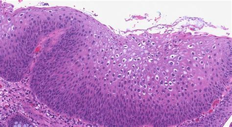 Your pathology report for low grade squamous intraepithelial lesion of the anal canal ...