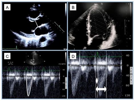 Development and Clinical Application of Left Ventricular–Arterial ...