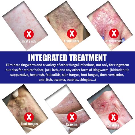 SISTIKOKO Extra Strength Toenail Fungus Treatment For Toenail India | Ubuy