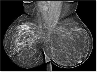 Breast Imaging Society, India