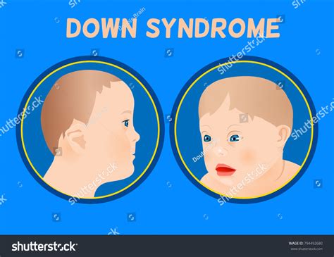 Signs Of Down Syndrome In Scan at Sylvia Partington blog