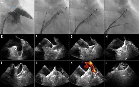 Left atrial appendage occlusion - EuroIntervention