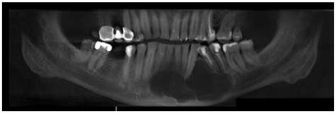 Traumatic Bone Cyst Jaw