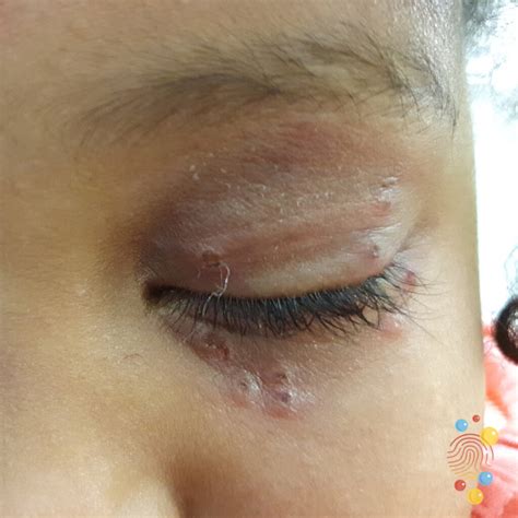 Eczema Herpeticum Eyelid at Lucinda Pell blog