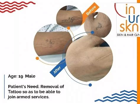 Safe Tattoo Removal Journey | Case Study 6 | InUrSkn