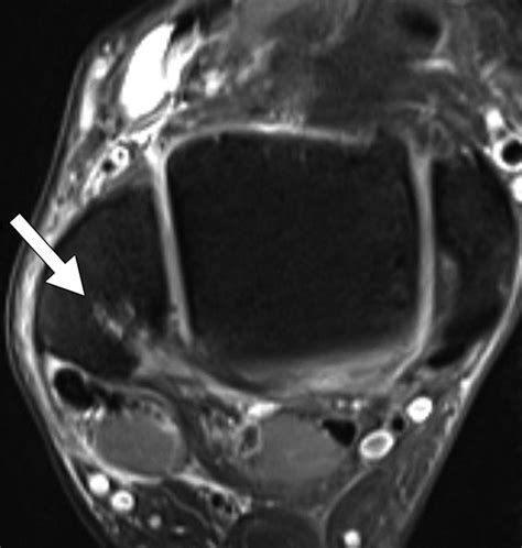 Bone Marrow Edema Patterns in the Ankle and Hindfoot: Distinguishing ...