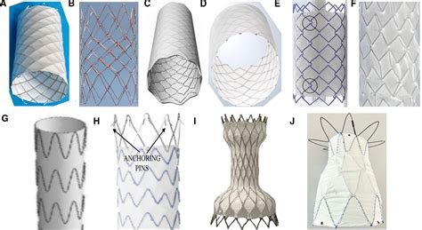 Covered Stent Correction for Sinus Venosus Atrial Septal Defects, an Emerging Alternative to ...