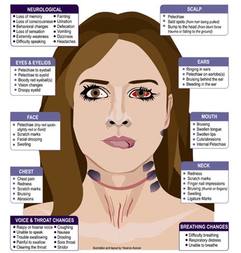 Image result for Famous Cases of Strangulation