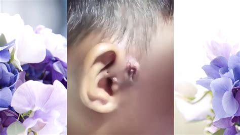 Image result for boils cysts abscesses exploding