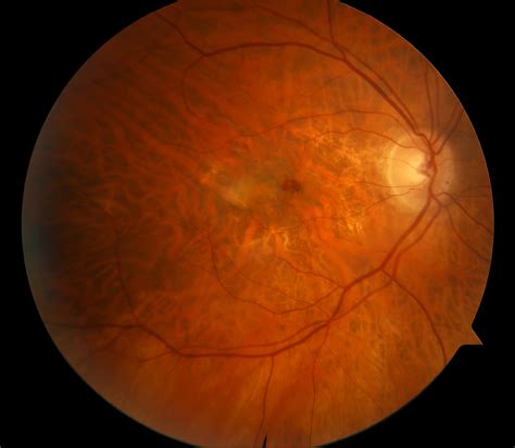 Wet Amd Dry & Wet AMD - Signs, Symptoms, and Diagnosis - Cure AMD ...