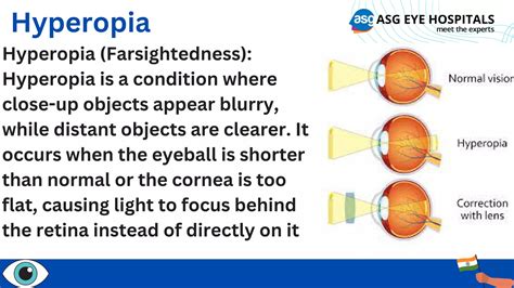 Image result for Common Eye Problems