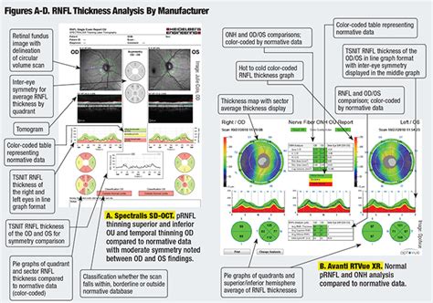 Image result for How to Use the Oct Scan in Optometry