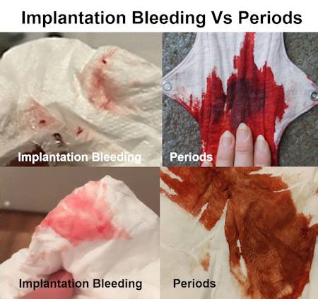 Implantation Bleeding vs. Period: Signs, Symptoms, and Key Differences