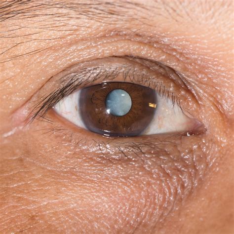 When is Cataract Surgery Needed? | Queens NY
