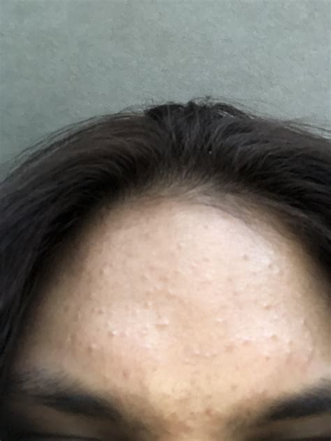 Closed comedones? [Acne] : r/SkincareAddiction