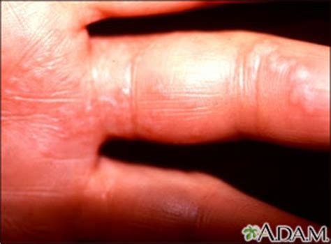 Herpes zoster (shingles) on the hand and fingers | Health Encyclopedia ...