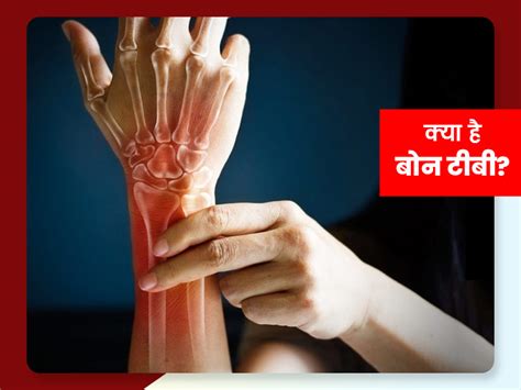Bone Tuberculosis Symptoms Causes and Prevention Tips in Hindi | क्या ...