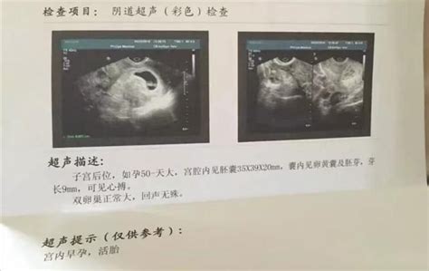 【怀孕18周】怀孕十八周胎儿图，怀孕18周胎动、饮食注意事项-昕薇网