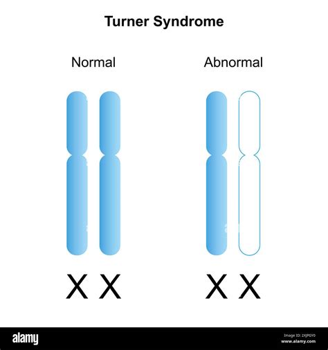 Turner Syndrome Chromosomes