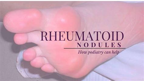 Foot Nodule On Sole