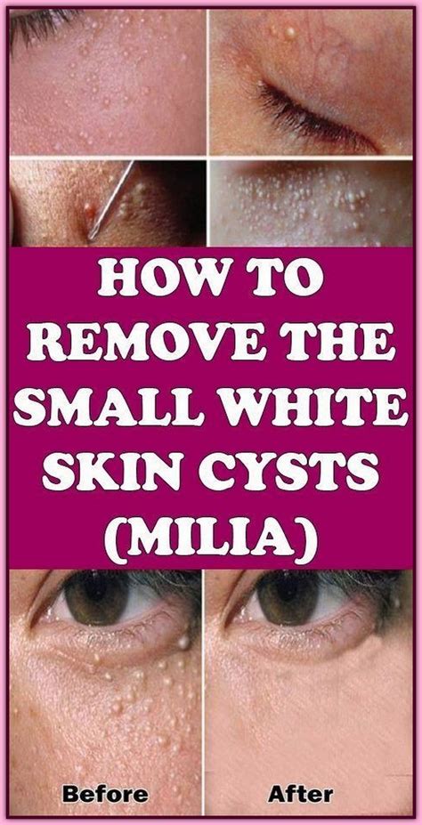 Milia how to remove – Artofit