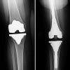 What are the results of total Knee Replacement? | Dr. Ramneek Mahajan