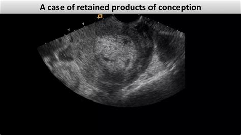 Retained products of conception dr.mohamed Soliman | PDF