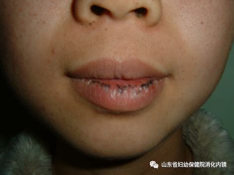 男孩嘴唇长斑，确诊为这个病……_医学界-助力医生临床决策和职业成长