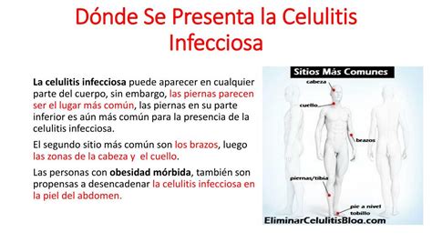 PPT - Celulitis Infecciosa: Causas, Síntomas y Tratamiento PowerPoint Presentation - ID:7704441