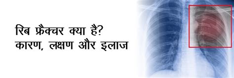 रिब फ्रैक्चर क्या है? कारण, लक्षण और इलाज | Rib Fracture in Hindi