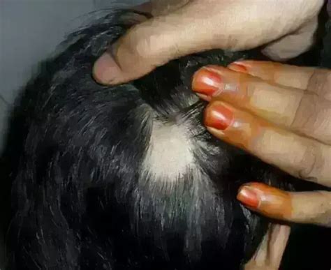 Oral tofacitinib effective for treating alopecia areata in children: Study