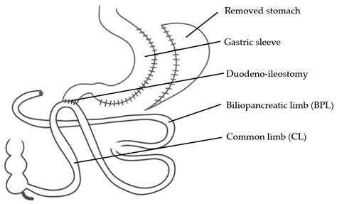 Bariatric Surgery–How Much Malabsorption Do We Need?—A Review of ...