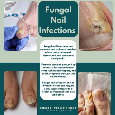 Nail Polish And Fungal Infection