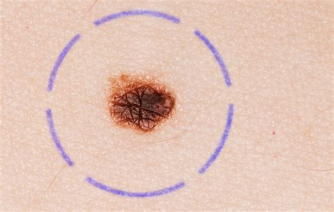What does melanoma look like in early stages | Symptoms and pictures