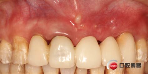前牙固定义齿修复前的牙周手术准备-山西牙周刘勇的博客-KQ88口腔博客