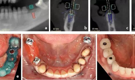 Robotic computer-assisted implant surgery promising for placing dental ...
