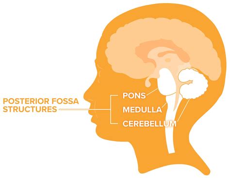 Posterior Fossa Syndrome – Causes, Symptoms & Management