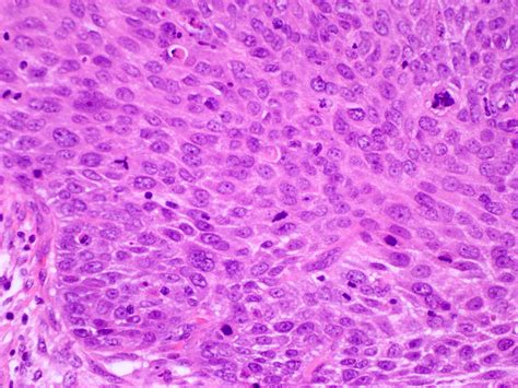 Is Squamous Cell Carcinoma Lung Cancer - Infoupdate.org